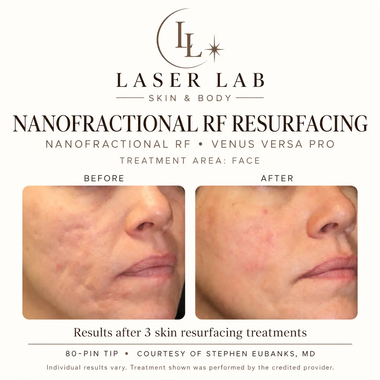 The Resurfacing Facial before and after — acne scarring