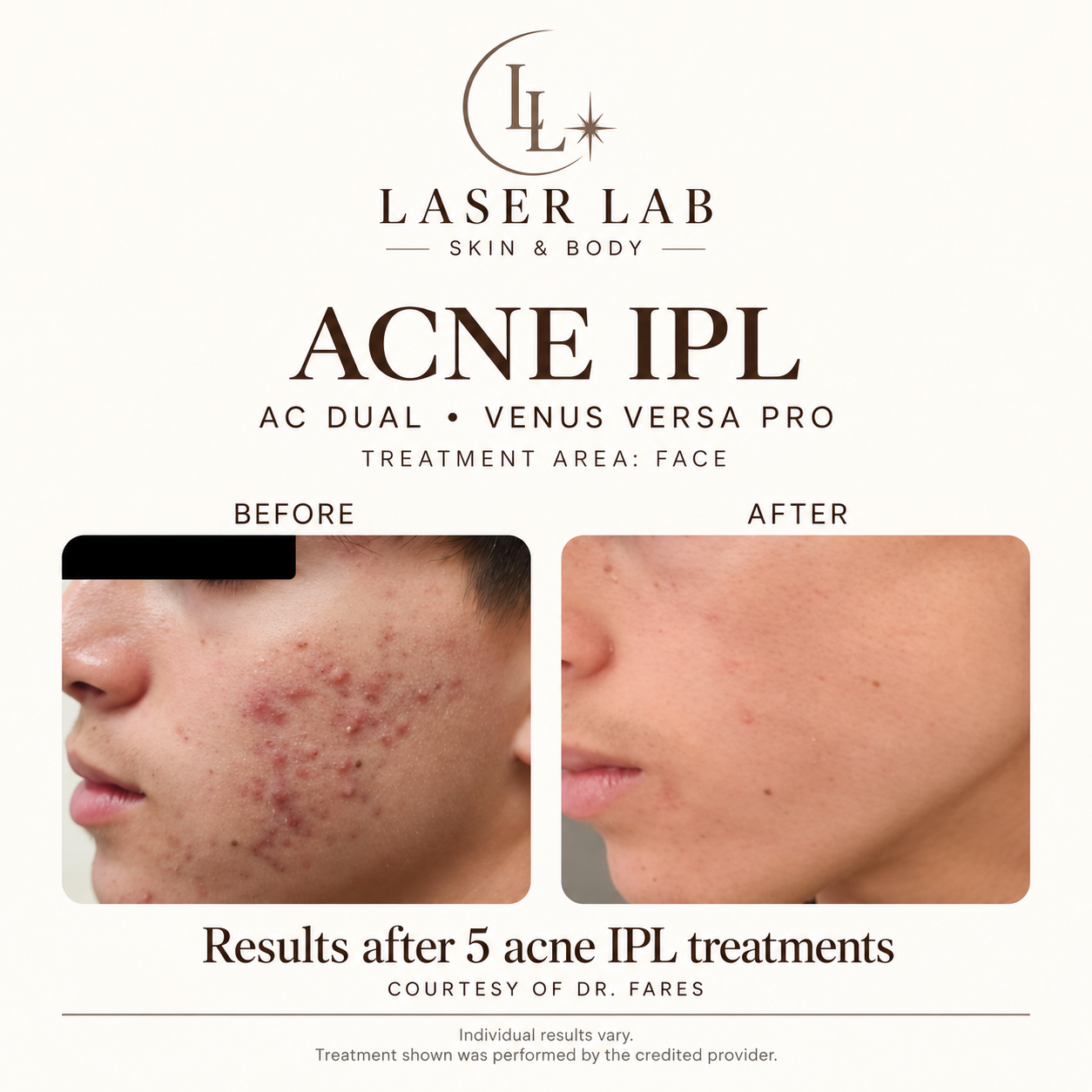 Acne IPL before and after