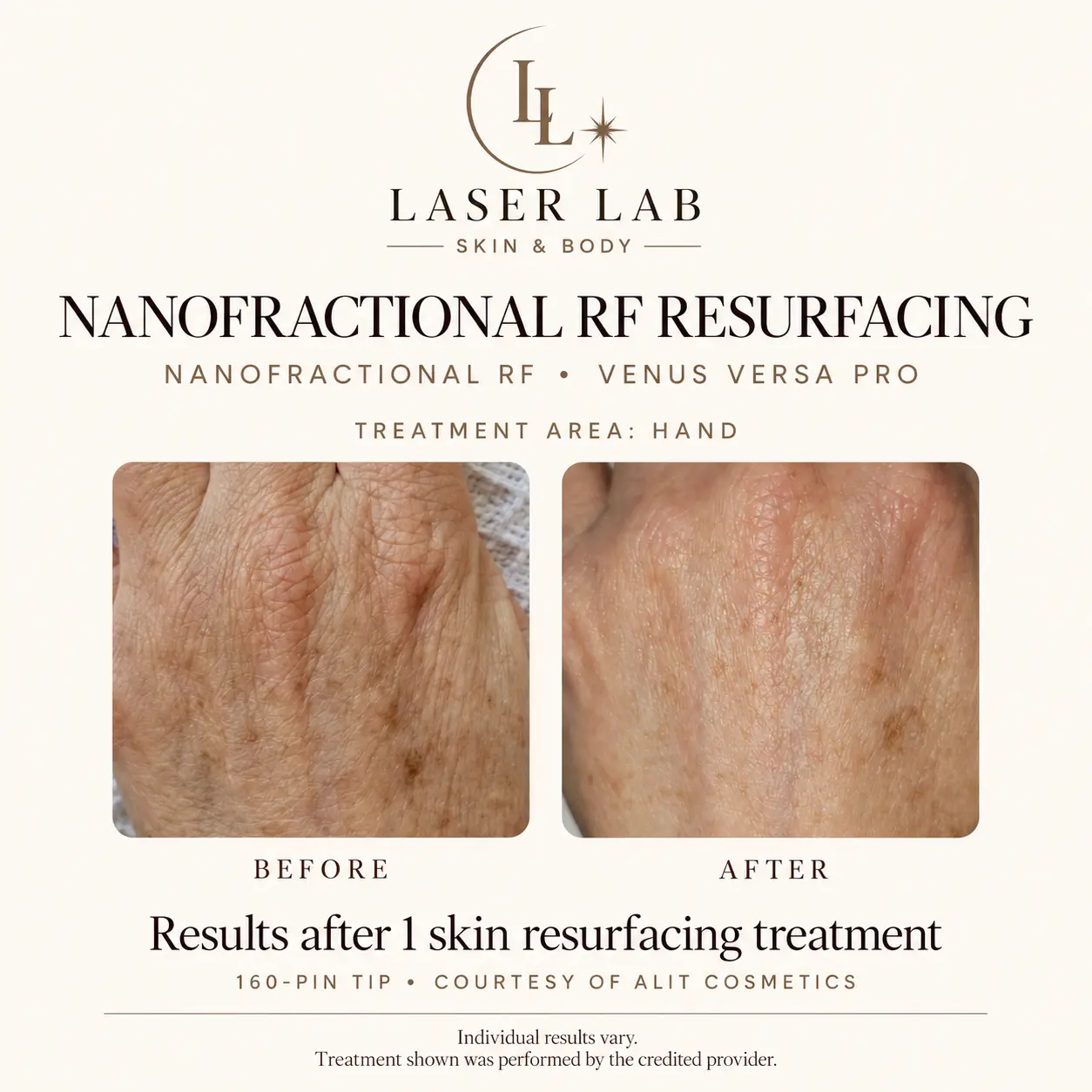 The Resurfacing Facial before and after — hands