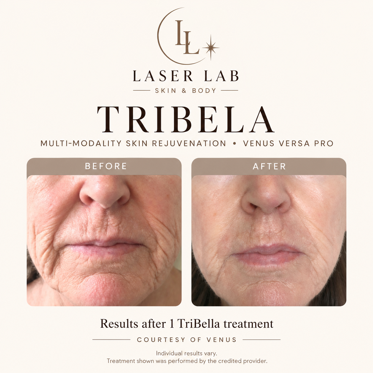 The Skin Reset — TriBella before and after