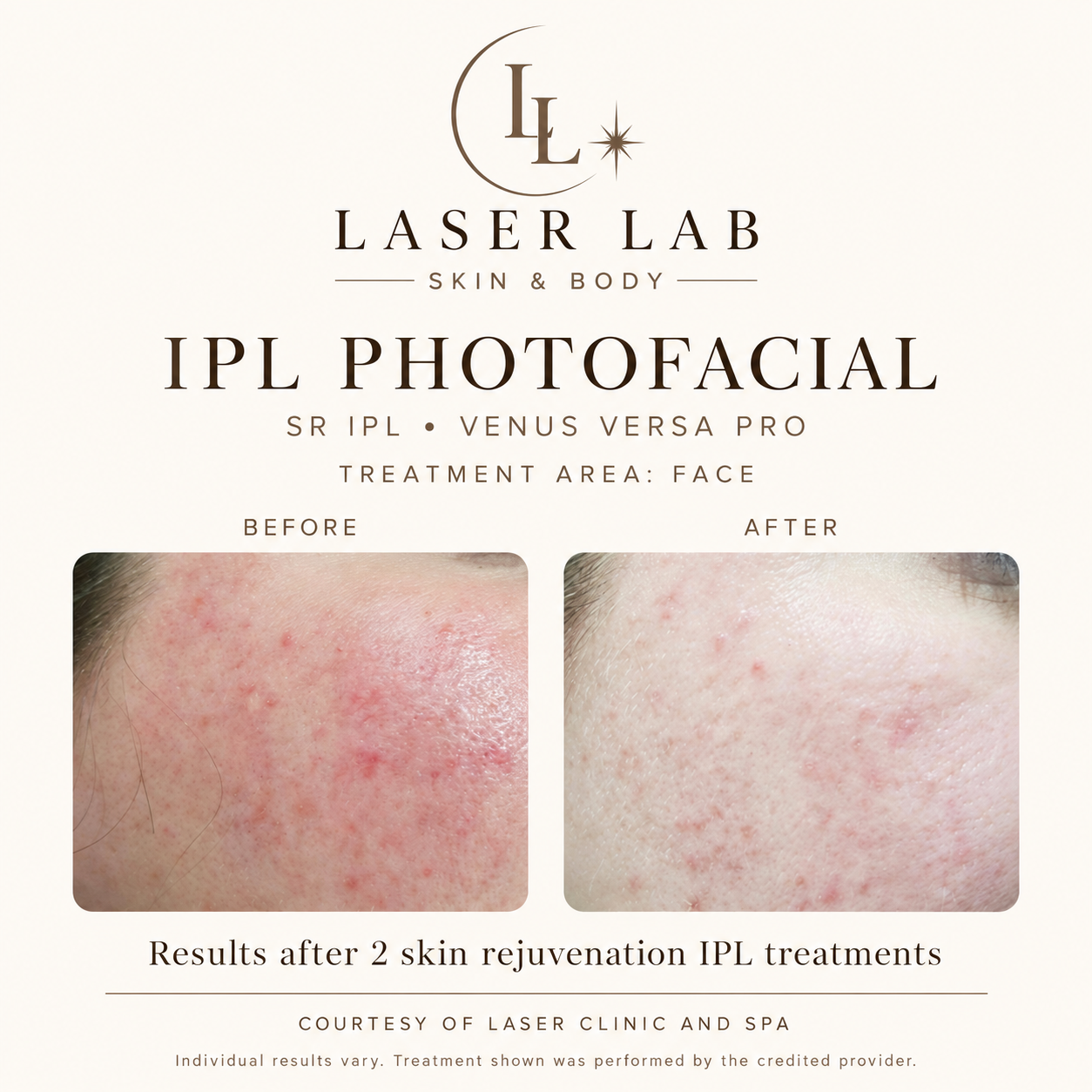 The Photofacial before and after