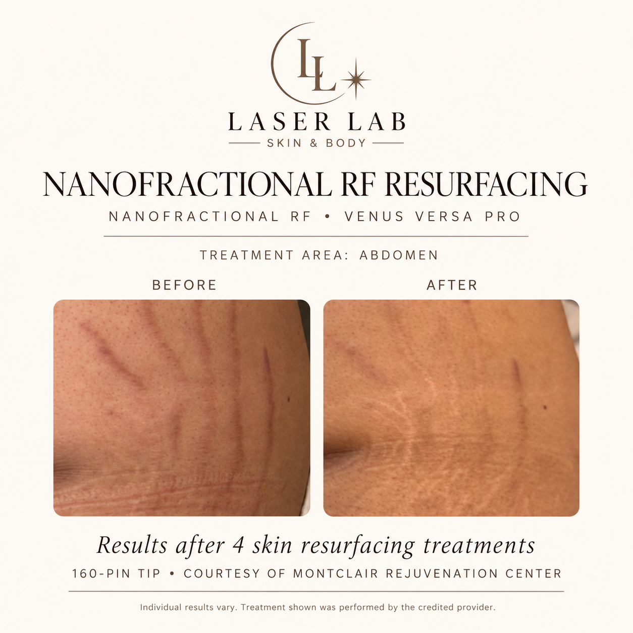The Resurfacing Facial before and after — abdomen