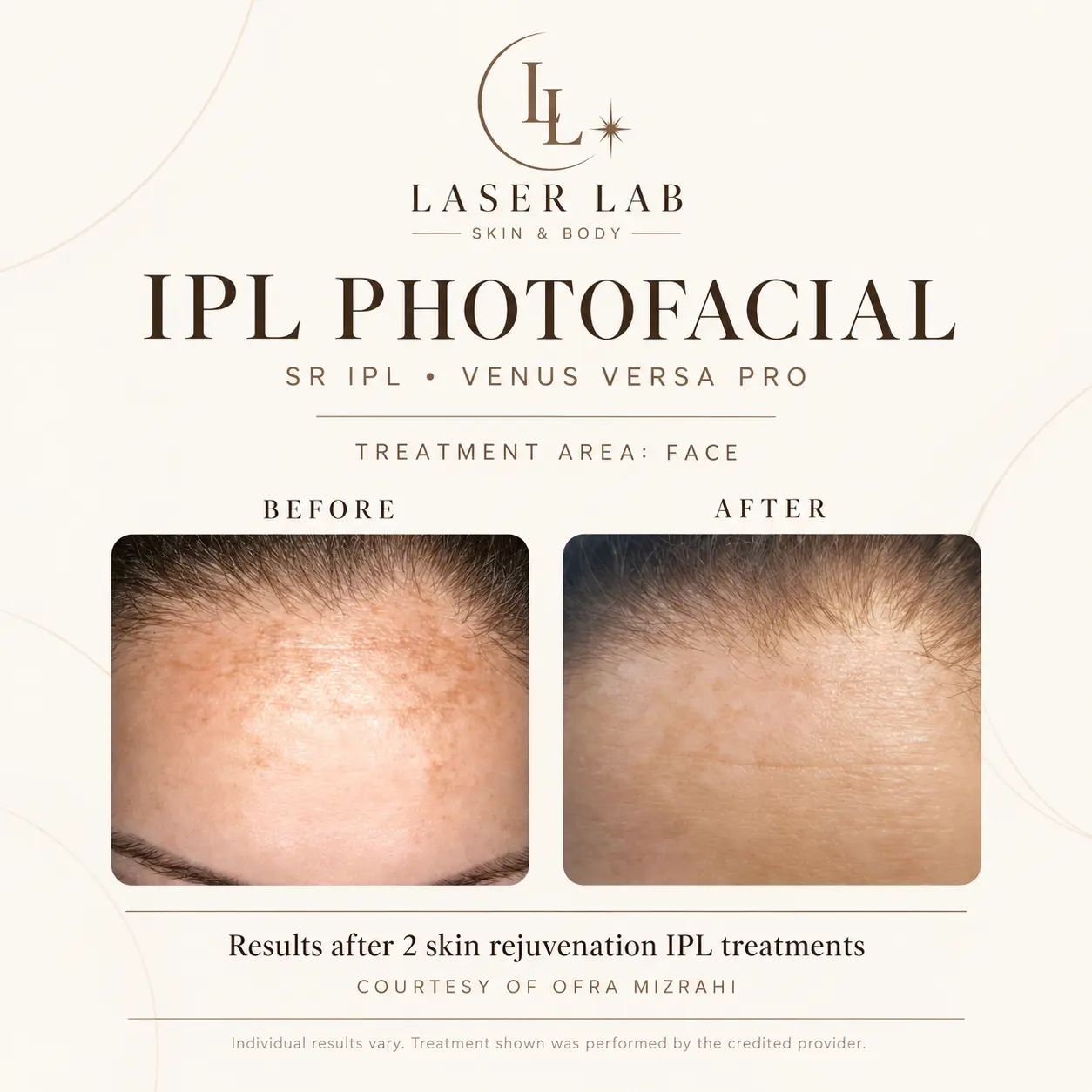 The Photofacial before and after