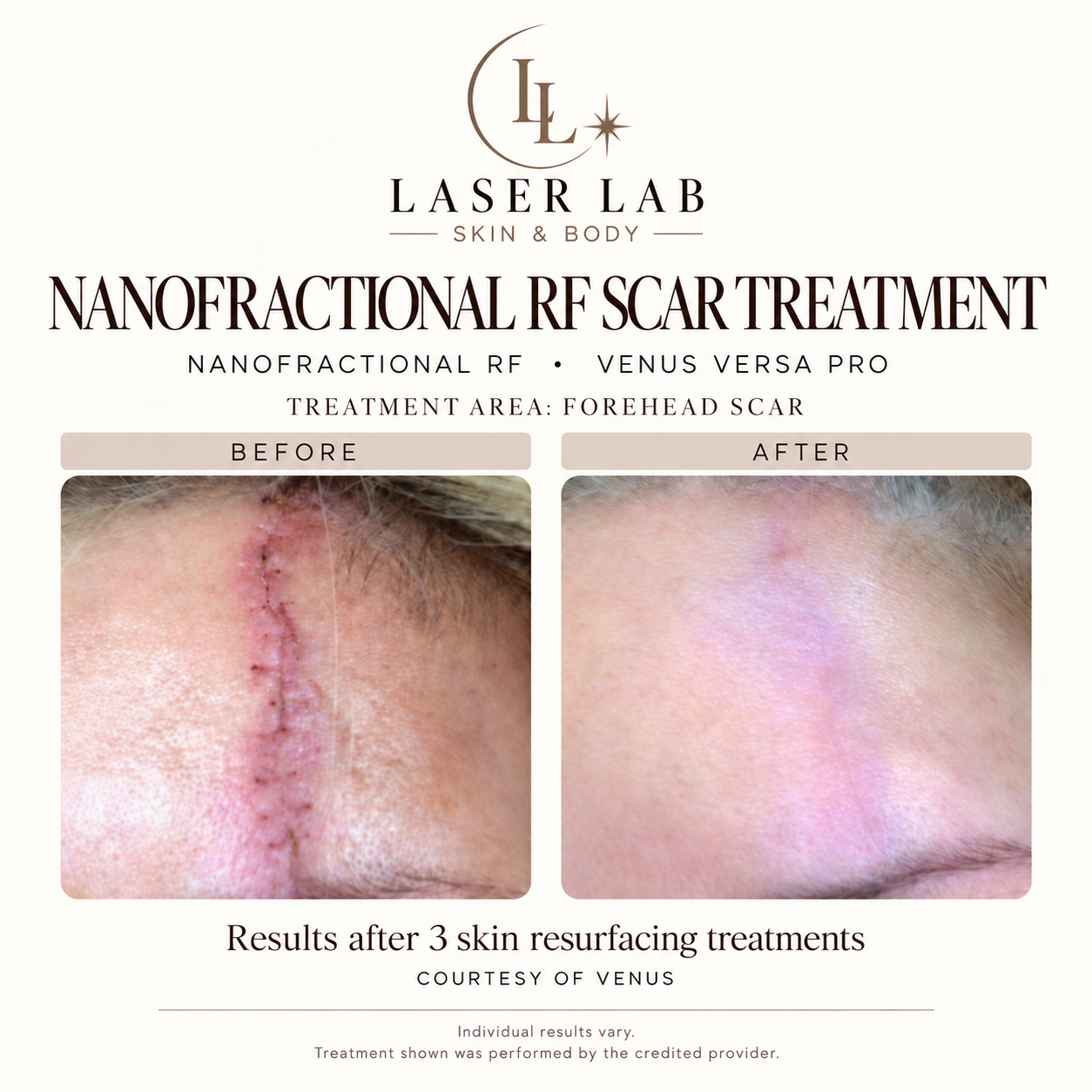 The Resurfacing Facial before and after — scar treatment