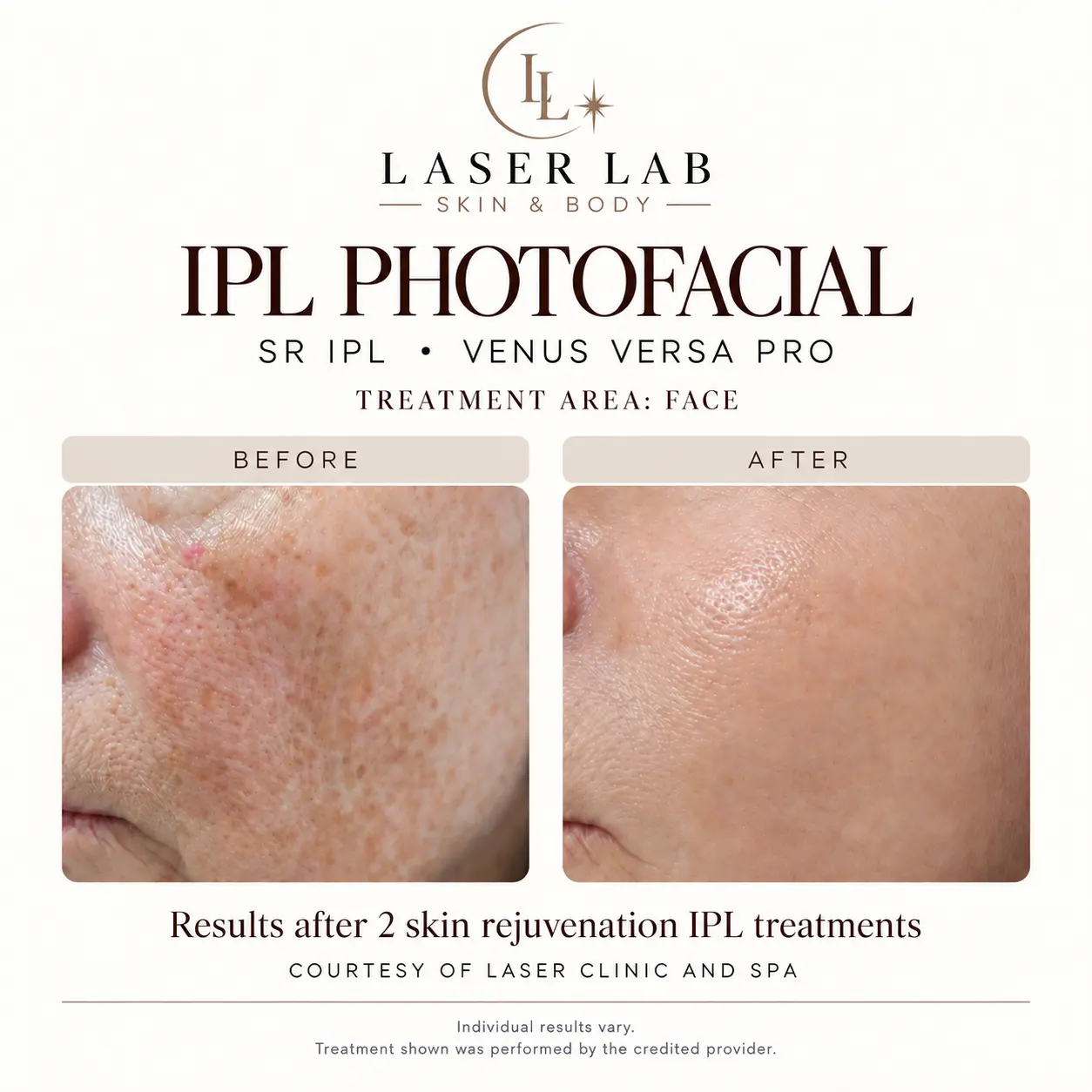 The Photofacial before and after